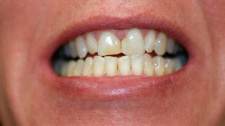 Before bleaching/bonding